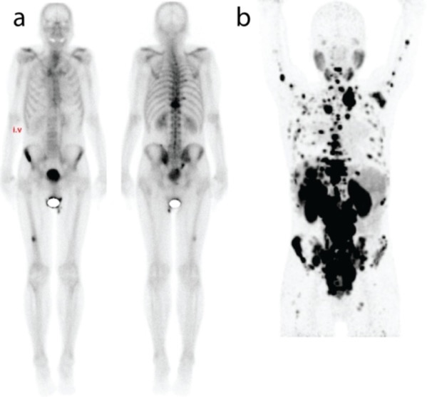 Botscan vs PSMA PET scan