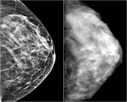 Mammogram oud en nieuw